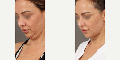 Neck Lift before and after photo