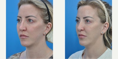 Rhinoplasty before and after photo