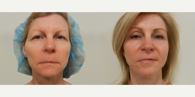 Brow Lift before and after photo