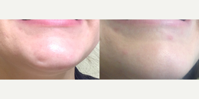 Botox before and after photo