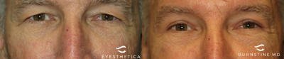 Brow Lift before and after photo