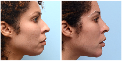 Chin Implant before and after photo