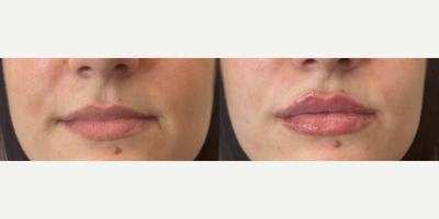 Lip Fillers before and after photo