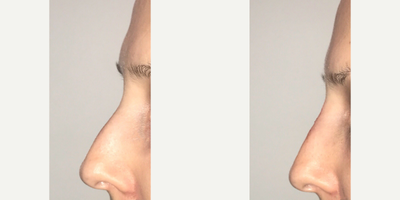 Nonsurgical Nose Job before and after photo