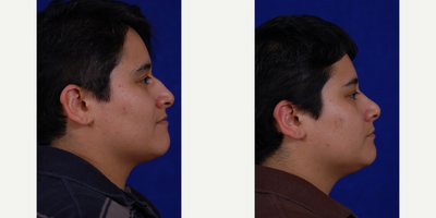 Rhinoplasty before and after photo