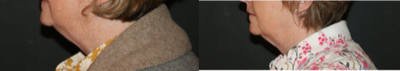 CoolMini before and after photo