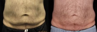 CoolSculpting before and after photo