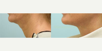 Facelift before and after photo