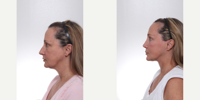 Facial Fat Transfer before and after photo