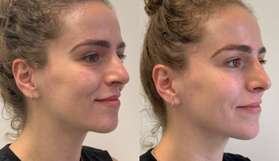 Restylane Defyne before and after photo