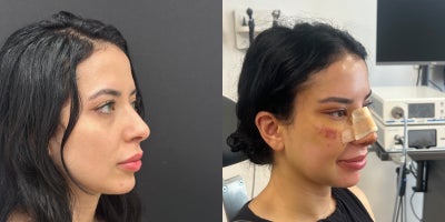 Rhinoplasty before and after photo