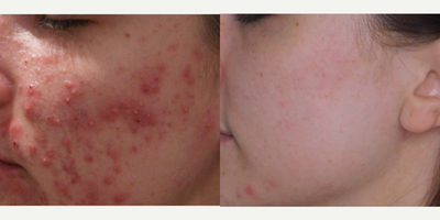 Accutane before and after photo