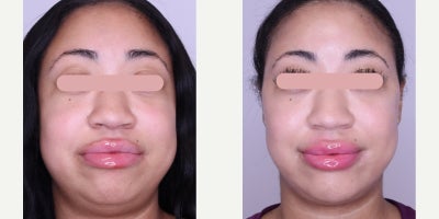 Cheek Fillers before and after photo
