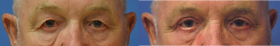 Eyelid Surgery before and after photo