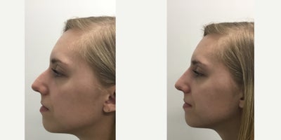 Nonsurgical Nose Job before and after photo