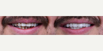 Porcelain Veneers before and after photo