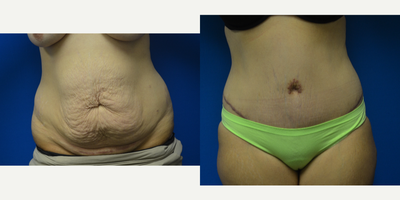 Tummy Tuck before and after photo