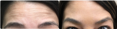 Botox before and after photo