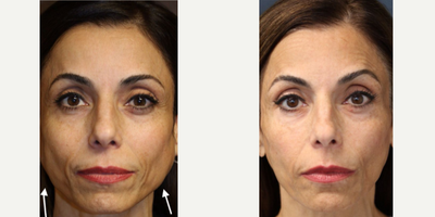 Botox before and after photo