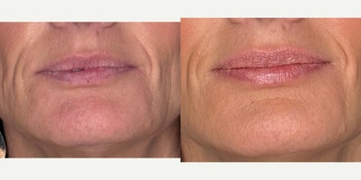 Botox before and after photo