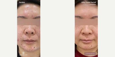 HydraFacial before and after photo