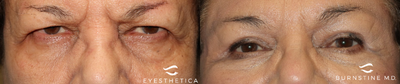 Brow Lift before and after photo