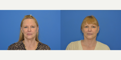 Neck Lift before and after photo