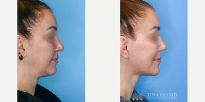Neck Lift before and after photo
