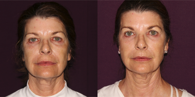 Sculptra before and after photo