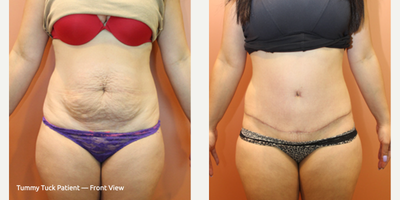 Tummy Tuck before and after photo