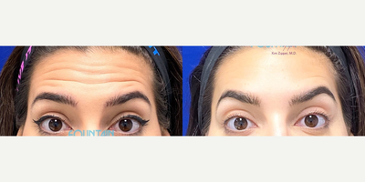 Botox before and after photo