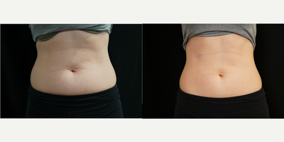 CoolSculpting before and after photo