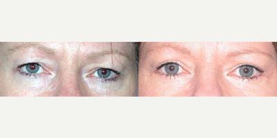 Eyelid Surgery before and after photo