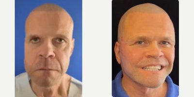 Facelift before and after photo