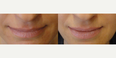 Lip Fillers before and after photo