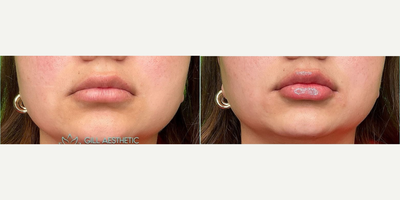 Lip Fillers before and after photo