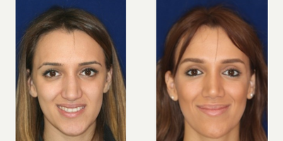 Rhinoplasty before and after photo