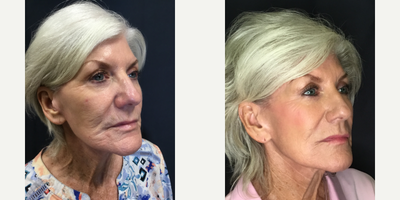 TempSure Envi before and after photo