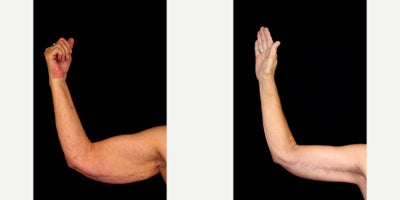 Arm Lift before and after photo
