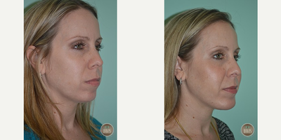 Chin Implant before and after photo