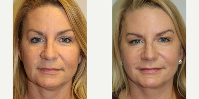 Facelift before and after photo