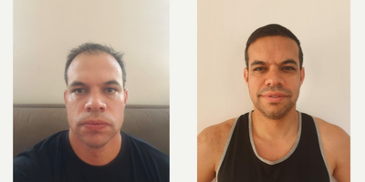 Hair Transplant before and after photo