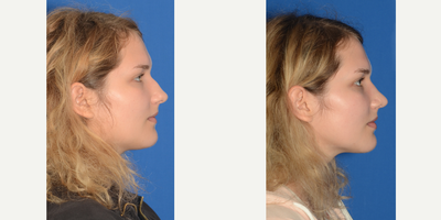 Rhinoplasty before and after photo