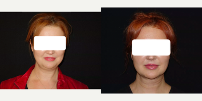 Chin Liposuction before and after photo