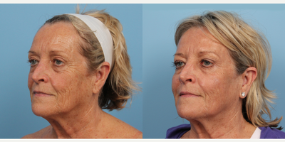 CO2 Laser before and after photo