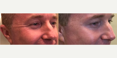 Dysport before and after photo