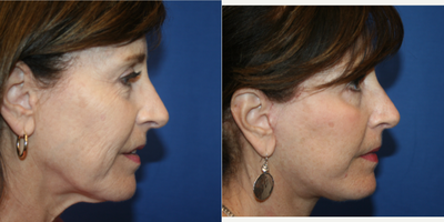 Facelift before and after photo