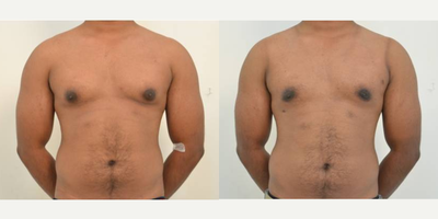Gynecomastia Surgery before and after photo