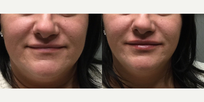 Juvederm before and after photo