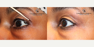 Mole Removal before and after photo